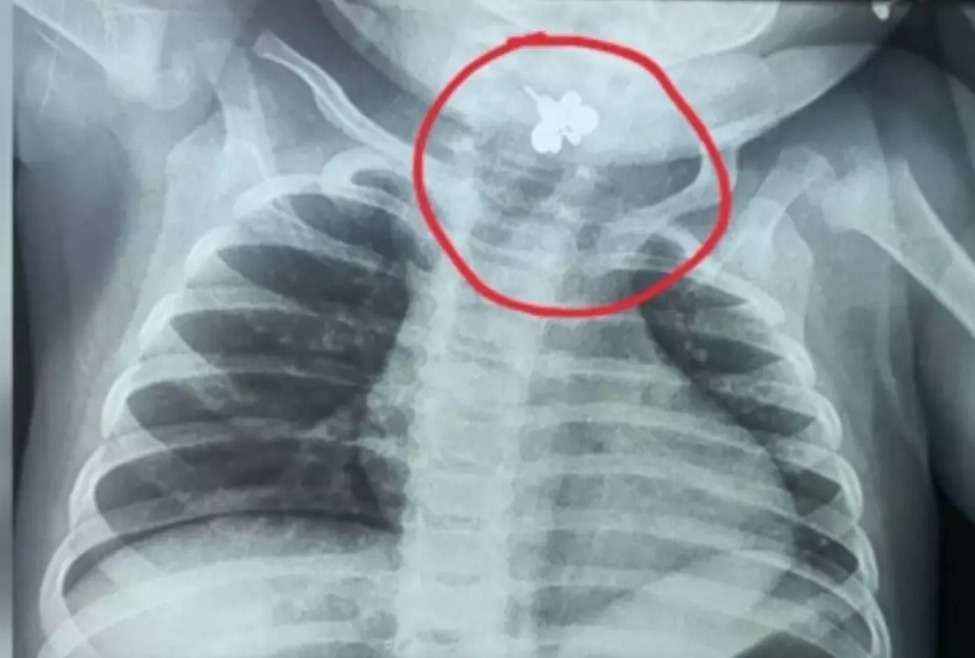 Descubren anillo atorado en la garganta de una bebé